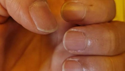 对话咬掉穿戴甲救人的韶关护士：指甲很痛，但更担心阻碍抢救